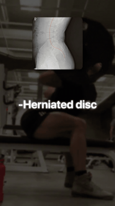 Here you need a disc, an anterior pelvic tilt, scoliosis, sciatica, yo